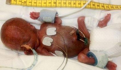 Urodzony w 25 tygodniu ciąży wcześniak przeżył, choć nikt ...