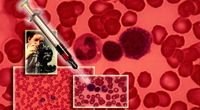 Malaria, HIV i gru�lica w odwrocie