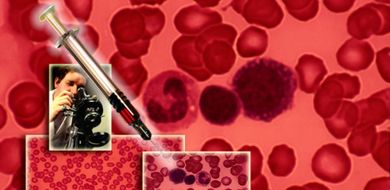 Malaria, HIV i gru�lica w odwrocie