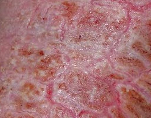 Syndrom Morgellon�w. Najdziwniejsza choroba �wiata atakuje