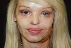 Katie Piper przez wypadkiem