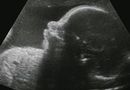 Choroby dziecka mo�na wykry� we krwi matki