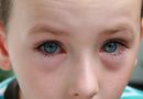 A mo�e to alergia?