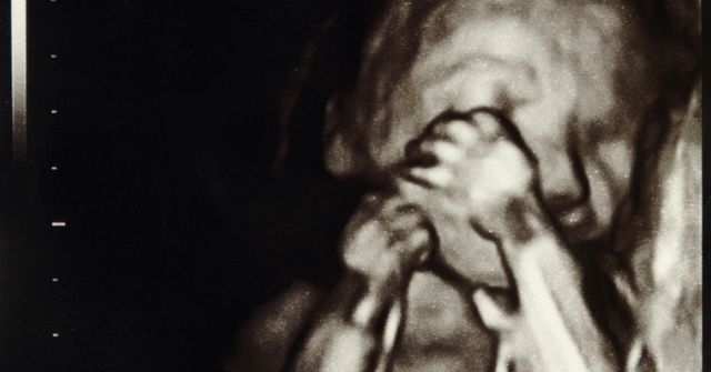 20 недель беременности кружится голова